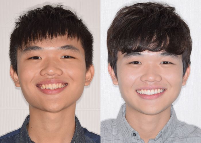 Invisalign Final Update - Before and After