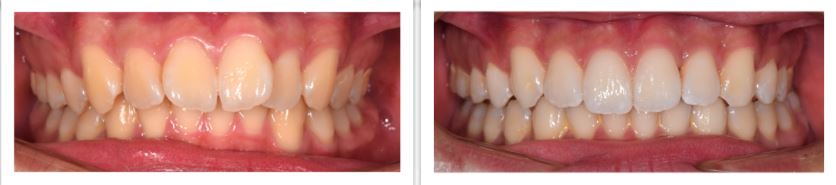 Invisalign Final Update - Before and After